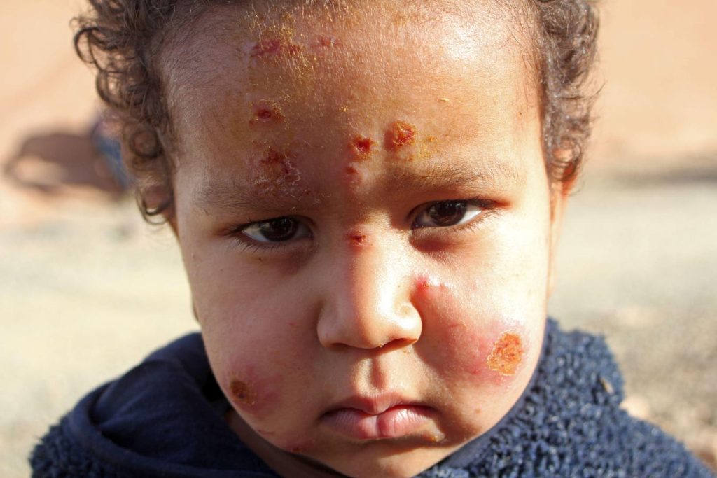 A Disfiguring Parasite From Sand Flies Is Endemic In The U.S.